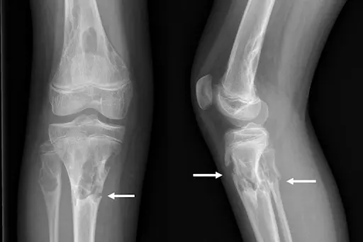 Chụp X-quang giúp bác sĩ xác nhận các tổn thương xung quanh dây chằng bị đứt